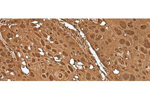 Immunohistochemistry of paraffin-embedded Human esophagus cancer tissue using VCP Polyclonal Antibody at dilution of 1:30(x200) (VCP Antikörper)