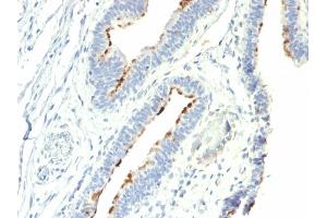 Formalin-fixed, paraffin-embedded human Colon Carcinoma stained with T-F Antigen / CD176 Mouse Monoclonal Antibody (A78-G/A7). (CD176 Antikörper)