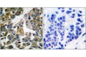 Immunohistochemistry analysis of paraffin-embedded human breast carcinoma tissue, using PLCG1 (Ab-783) Antibody. (Phospholipase C gamma 1 Antikörper  (AA 751-800))