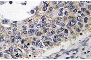 Immunohistochemistry (IHC) analyzes of PRX III antibody in paraffin-embedded human lung carcinoma tissue. (Peroxiredoxin 3 Antikörper)