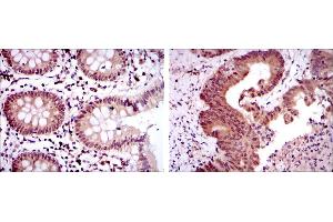 Immunohistochemical analysis of paraffin-embedded colon tissues (left) and colon cancer tissues (right) using OTX2 mouse mAb with DAB staining. (OTX2 Antikörper)