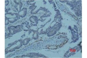 Immunohistochemical analysis of paraffin-embedded human colon caricnoma using Survivin Monoclonal Antibody. (Survivin Antikörper)