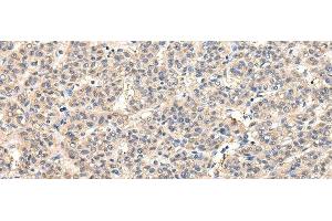 Immunohistochemistry of paraffin-embedded Human liver cancer tissue using VPS45 Polyclonal Antibody at dilution 1:50 (VPS45 Antikörper)