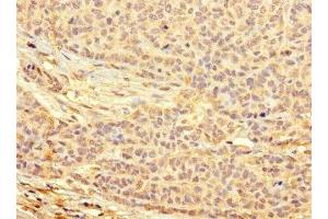 Immunohistochemistry of paraffin-embedded human ovarian cancer using ABIN7166432 at dilution of 1:100 (METTL21C Antikörper  (AA 6-145))