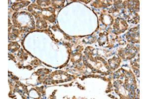 The image on the left is immunohistochemistry of paraffin-embedded Human thyroid cancer tissue using ABIN7189774(ALDH9A1 Antibody) at dilution 1/50, on the right is treated with synthetic peptide. (ALDH9A1 Antikörper)