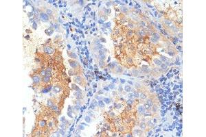 Immunohistochemistry of paraffin-embedded Human lung cancer using SEMA4C Polyclonal Antibody at dilution of 1:100 (40x lens). (SEMA4C Antikörper)