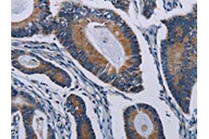 The image on the left is immunohistochemistry of paraffin-embedded Human colon cancer tissue using ABIN7191806(PCDHAC2 Antibody) at dilution 1/50, on the right is treated with synthetic peptide. (PCDHAC2 Antikörper)