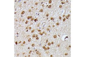 Immunohistochemistry of paraffin-embedded human esophageal cancer using KI Rabbit pAb (ABIN7269712) at dilution of 1:250 (40x lens). (Protein Virilizer Homolog (VIRMA) (AA 1400-1700) Antikörper)