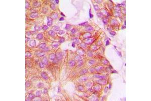 Immunohistochemical analysis of FHIT staining in human breast cancer formalin fixed paraffin embedded tissue section. (FHIT Antikörper  (Center))