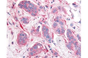 Anti-ERBB2 / HER2 antibody IHC of human breast carcinoma, neoplastic cells. (ErbB2/Her2 Antikörper  (Cytoplasmic Domain))