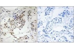 Immunohistochemistry analysis of paraffin-embedded human breast carcinoma, using SGOL2 Antibody. (SGOL2 Antikörper  (AA 681-730))