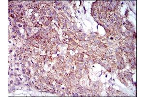 Immunohistochemical analysis of paraffin-embedded esophageal cancer tissues using MRPL42 mouse mAb with DAB staining.