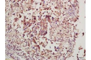 Formalin-fixed and paraffin embedded rat lung carcinoma labeled with Anti-phospho-P70 S6 Kinase beta (Thr228) Polyclonal Antibody, Unconjugated (ABIN732608) at 1:200, followed by conjugation to the secondary antibody and DAB staining (RPS6KB2 Antikörper  (pThr228))