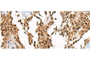 Immunohistochemistry of paraffin-embedded Human ovarian cancer tissue using ATE1 Polyclonal Antibody at dilution of 1:60(x200) (ATE1 Antikörper)