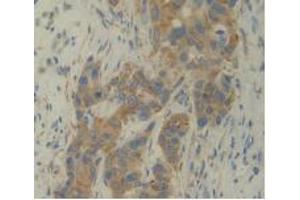 IHC-P analysis of Human Breast Cancer Tissue, with DAB staining. (IL12A Antikörper  (AA 23-219))