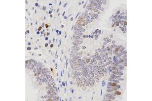 Immunohistochemistry of paraffin-embedded human rectal cancer tissue using SCTR antibody at dilution of 1:200 (x400 lens) (SCTR Antikörper)