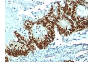Formalin-fixed, paraffin-embedded human Colon Carcinoma stained with p53 Mouse Monoclonal Antibody (DO-1). (p53 Antikörper)