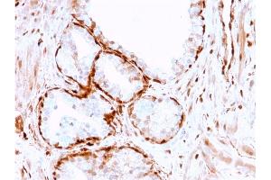 Formalin-fixed, paraffin-embedded human Prostate Tumor stained with AKR1B1 Mouse Monoclonal Antibody (CPTC-AKR1B1-3).