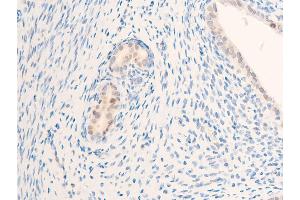 ABIN6267284 at 1/100 staining rat uterine cancer tissue sections by IHC-P. (ErbB2/Her2 Antikörper  (pTyr877))