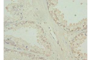 Immunohistochemistry of paraffin-embedded human prostate cancer using ABIN7173754 at dilution of 1:100 (TBCE Antikörper  (AA 328-527))