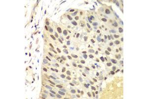 Immunohistochemistry of paraffin-embedded human lung cancer using FEN1 antibody at dilution of 1:100 (400x lens). (FEN1 Antikörper)