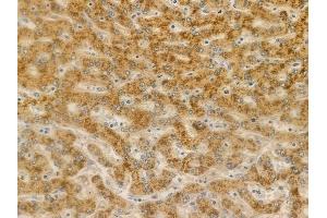 ABIN6256988 and ABIN6275146 at 1/100 staining human hepatocellular carcinoma by IHC-P. (GJC2 Antikörper  (N-Term))