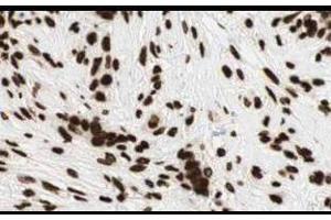Affinity Purified anti-Gli2 antibody shows strong cytoplasmic and membranous staining of tumor cells in human breast tissue. (GLI2 Antikörper  (Internal Region))