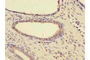 Immunohistochemistry of paraffin-embedded human prostate cancer using ABIN7170815 at dilution of 1:100 (HSPA9 Antikörper  (AA 458-679))