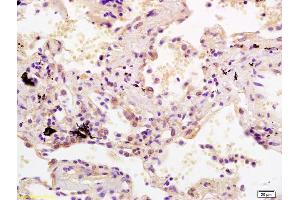 Formalin-fixed and paraffin embedded human lung carcinoma labeled with Rabbit Anti SDHC Polyclonal Antibody, Unconjugated (ABIN1385318) at 1:200 followed by conjugation to the secondary antibody and DAB staining (SDHC Antikörper  (AA 81-169))