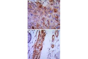 Immunohistochemical analysis of paraffin-embedded human lung cancer (A) and colon cancer (B) using VCAM1 monoclonal antobody, clone 6G9  with DAB staining. (VCAM1 Antikörper)