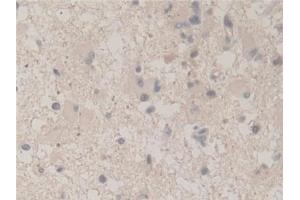 Detection of UBA52 in Human Glioma Tissue using Polyclonal Antibody to Ubiquitin A 52 Residue Ribosomal Protein Fusion Product 1 (UBA52)