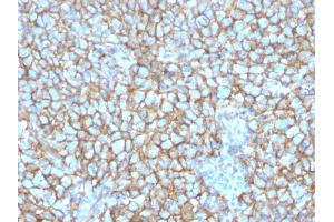 Formalin-fixed, paraffin-embedded human Melanoma stained with MCAM Mouse Monoclonal Antibody (MCAM/3048). (MCAM Antikörper  (AA 226-374))