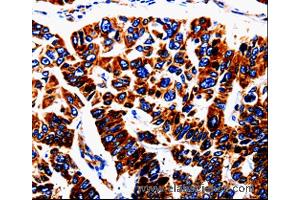 Immunohistochemistry of Human lung cancer using UTS2 Polyclonal Antibody at dilution of 1:50 (Urotensin 2 Antikörper)
