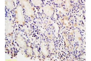 Formalin-fixed and paraffin embedded human gastric carcinoma tissue labeled with Anti-PAF Polyclonal Antibody, Unconjugated at 1:200 followed by conjugation to the secondary antibody and DAB staining (KIAA0101 Antikörper)