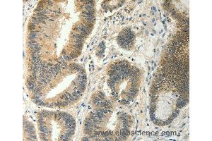 Immunohistochemistry of Human thyroid cancer using SOCS5 Polyclonal Antibody at dilution of 1:35