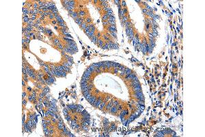 Immunohistochemistry of Human ovarian cancer using IGFBP7 Polyclonal Antibody at dilution of 1:50 (IGFBP7 Antikörper)