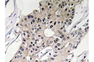 Immunohistochemistry analyzes of Defensin alpha-1 antibody in paraffin-embedded human breast carcinoma tissue. (alpha Defensin 1 Antikörper)