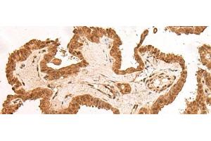 Immunohistochemistry of paraffin-embedded Human thyroid cancer tissue using ARMC8 Polyclonal Antibody at dilution of 1:40(x200) (ARMC8 Antikörper)