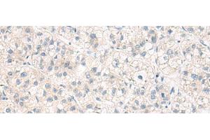 Immunohistochemistry of paraffin-embedded Human liver cancer tissue using ANKS6 Polyclonal Antibody at dilution of 1:55(x200) (ANKS6 Antikörper)