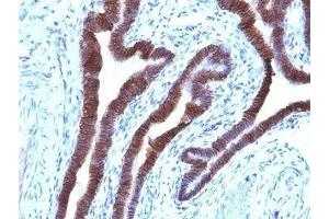 Formalin-fixed, paraffin-embedded human ovarian carcinoma stained with EpCAM antibody (EGP40/1110). (EpCAM Antikörper  (Cytoplasmic Domain))