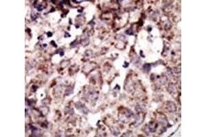 IHC analysis of FFPE human breast carcinoma tissue stained with the RAGE antibody