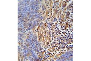Immunohistochemistry analysis in formalin fixed and paraffin embedded human lung carcinoma reacted with HLA-DRB5 Antibody (Center) followed which was peroxidase conjugated to the secondary antibody and followed by DAB staining. (HLA-DRB5 Antikörper  (Middle Region))