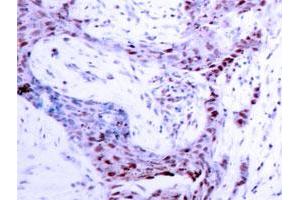 Immunohistochemistry analysis of paraffin-embedded human breast carcinoma tissue with PRNP (phospho S190) polyclonal antibody . (PRNP Antikörper  (pSer190))