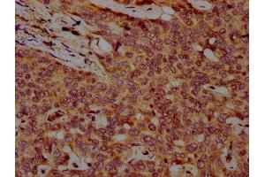 IHC image of ABIN7152402 diluted at 1:500 and staining in paraffin-embedded human liver cancer performed on a Leica BondTM system. (Cyclin F Antikörper  (AA 248-400))