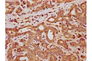 IHC image of ABIN7161592 diluted at 1:300 and staining in paraffin-embedded human liver cancer performed on a Leica BondTM system. (QPRT Antikörper  (AA 113-254))