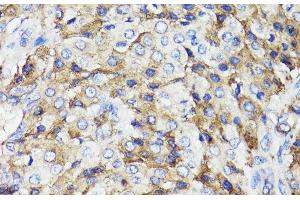Immunohistochemistry of paraffin-embedded Human lung cancer using CD59 Polyclonal Antibody at dilution of 1:100 (40x lens). (CD59 Antikörper)