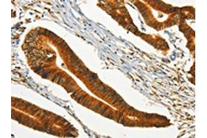 The image on the left is immunohistochemistry of paraffin-embedded Human colon cancer tissue using ABIN7190246(CHRDL2 Antibody) at dilution 1/20, on the right is treated with synthetic peptide. (CHRDL2 Antikörper)