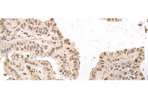 Immunohistochemistry of paraffin-embedded Human thyroid cancer tissue using HMGN2 Polyclonal Antibody at dilution of 1:35(x200) (HMGN2 Antikörper)