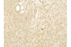 ABIN6260825 and ABIN6277501 at 1/100 staining human astrocytoma by IHC-P.