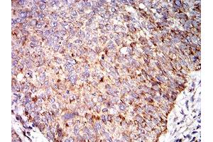 Immunohistochemical analysis of paraffin-embedded bladder cancer tissues using C3C mouse mAb with DAB staining. (Complement C3c Antikörper  (AA 1521-1649))